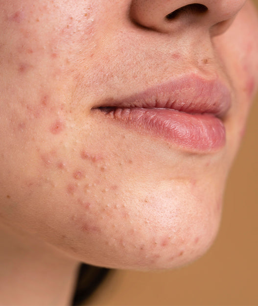 Acne & Breakouts