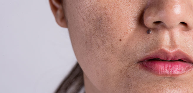 Dull & Uneven Skin